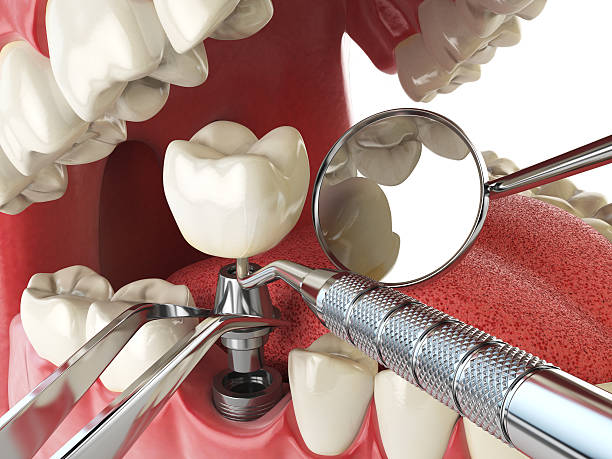 Best Knocked-Out Tooth (Avulsed Tooth) Treatment in Lookout Mountain, GA